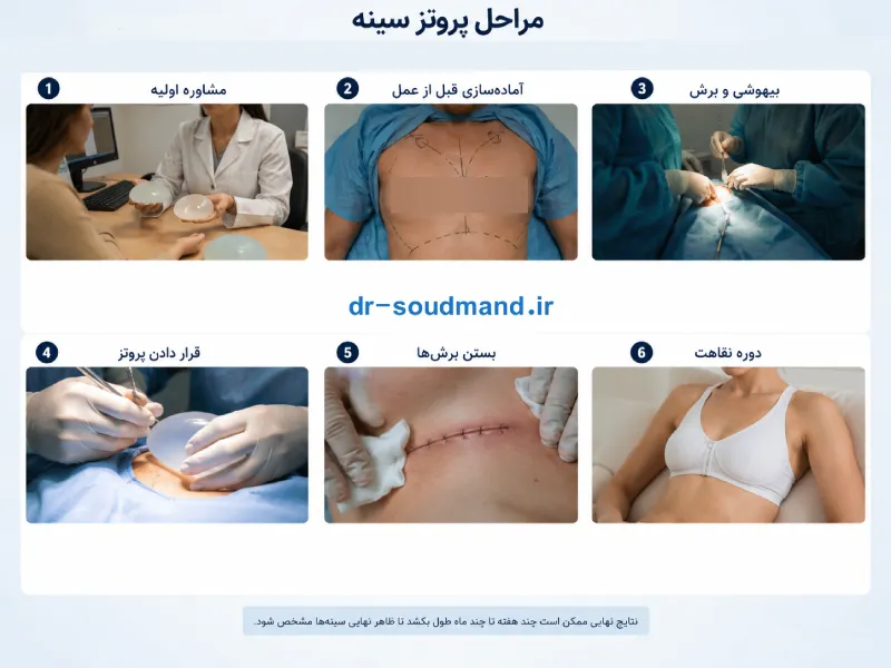 مراحل عمل پروتز